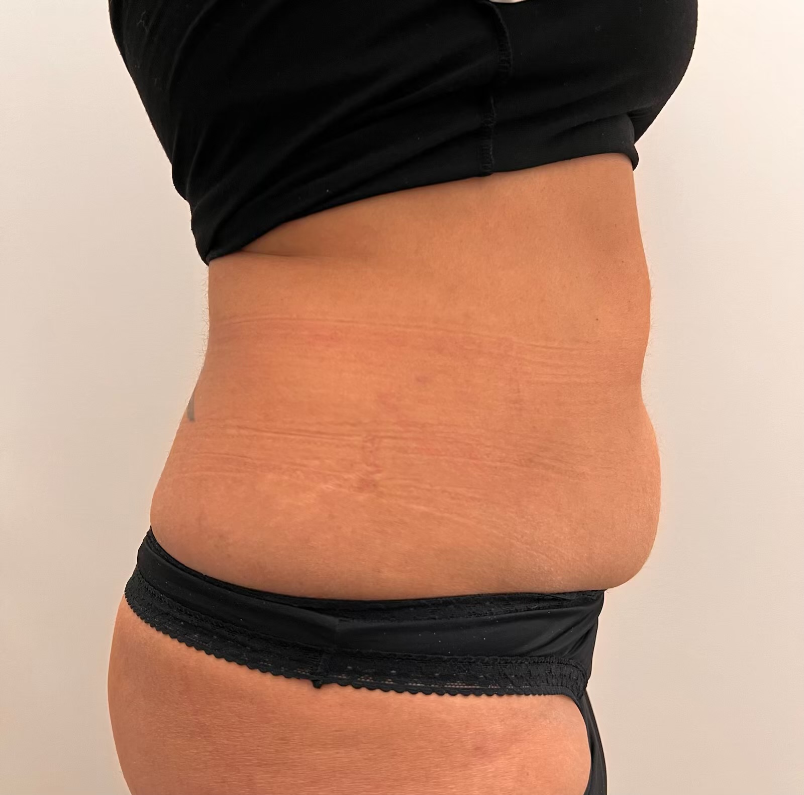 Side profile of a patient's abdomen before a course of Emsculpt treatment