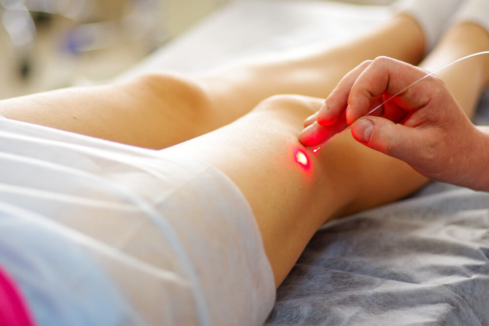 Close-up of a vascular laser handpiece treating a small spider vein on the leg, with a red guide light on skin in a clinical setting